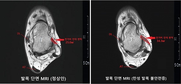 정상인과 발목염좌환자의 MRI 분석결과.