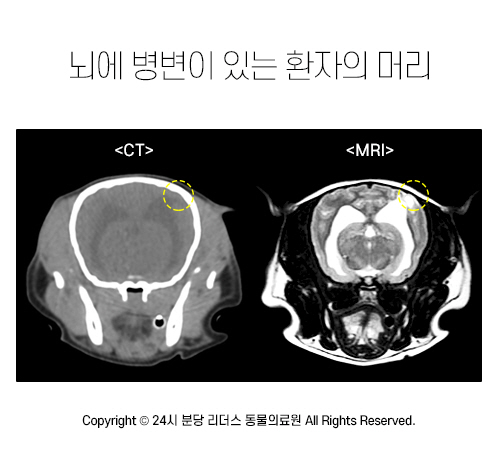 뇌에 병변이 있는 환자의 머리를 찍은 CT와 MRI 영상 비교. MRI 영상에서 동그라미 안 이상이 있는 부위가 매우 잘 보인다.