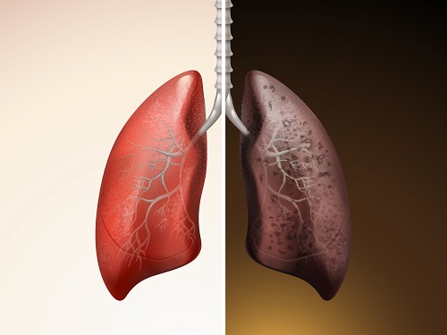 한번 손상된 폐는 회복할 수 없는 ‘비가역적’ 손상을 입기 때문에 기침, 가래, 숨이 찬 증상이 지속 된다면 병원을 찾아 진단받는 것이 좋다(사진설명: 클립아트코리아).