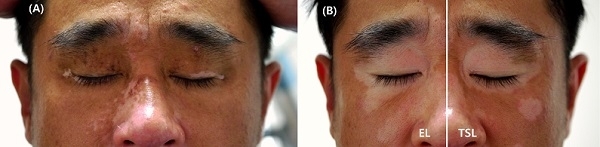 Improvements on vitiligo after laser therapy. (A) Before (B) After EL(excimer laser) and TSL(Pallas laser) treatment. (C): Lasers Surg. Med. 51:239–244, 2019