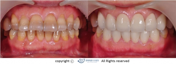 회색빛의 치아, 뚜렷한 줄무늬 등 치아가 만들어질 때부터 생긴 변색이다. 이때는 전체 치아색이 다르기 때문에 덮어씌우는 방법 말고는 대안이 없다.