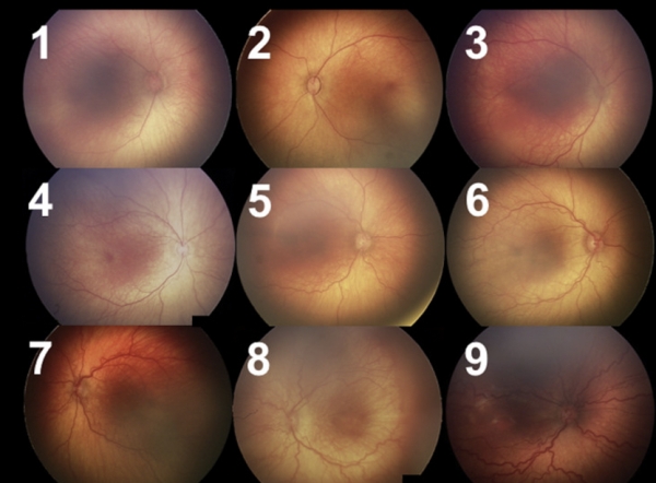사진. 1~9단계로 나눈 미숙아망막병증 중증도평가지표
