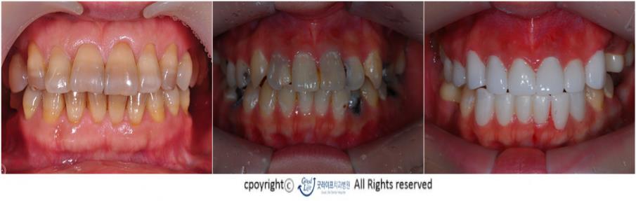치아에 충치가 있거나 예전에 치료한 재료가 있는 경우 라미네이트 자체가 불가능 할 수 있다.