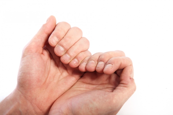 손발톱건강을 지키기 위해서는 평소 손발톱을 짧게 유지하고 보습제를 자주 발라주는 것이 좋다(사진=클립아트코리아).