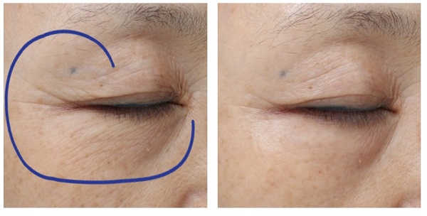 눈가 및 눈밑주름을 프랙셔널 고주파로 치료하기 전(왼쪽)과 후(오른쪽).