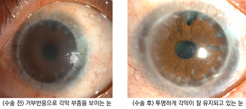 환자의 수술 전과 수술 후 눈의 상태.