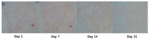 Skin changes after carbon dioxide fractional laser treatment