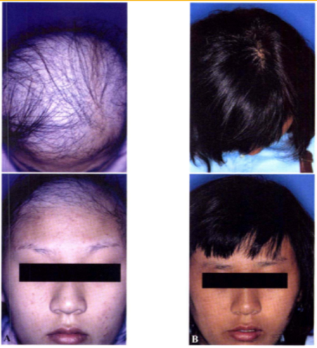 The efficacy of DPCP on patients with large hair loss area (A: Before treatment B: 11 months after treatment) © Therapeutic Effects of Topical Diphenylcyclopropenone (DPCP) for the Treatment of Extensive Alopecia Areata, Korean J Dermatol.. 2004;42(9):1130~1137.