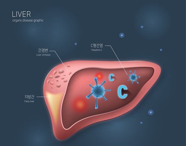Early diagnosis and treatment are very important as hepatitis C is considered to be the main cause of liver cancer, which has the greatest socioeconomic burden. Experts on liver diseases emphasize that the government should actively seek out patients with underlying hepatitis C, and the public should also be alert to the disease and try to prevent and manage it (image=ClipArt Korea).