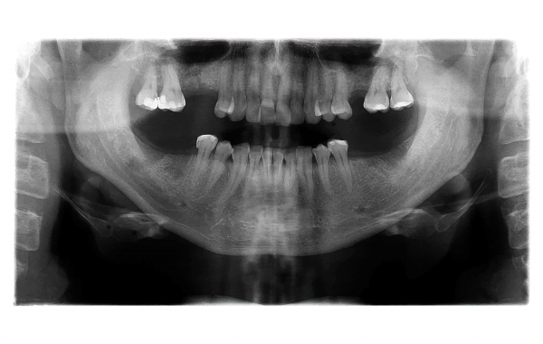 20세 전에 발견되는 치아종은 방치말고 즉시 제거하는 것이 좋다(사진=클립아트코리아).