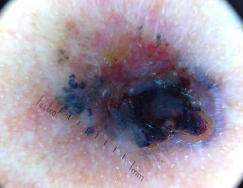 더모스코피로 살펴본 기저세포암의 모습.