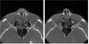 Before(left) and after(right) nasal fracture surgery shown with 3D CT