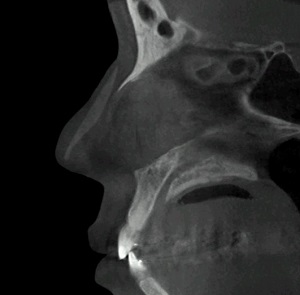 3D-CT로 확인한 코. 울툴불퉁한 콧등 아래로 보이는 하얀 물체가 인공보형물(실리콘)이다(사진=GNG병원).