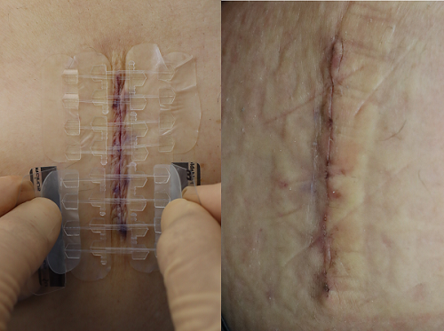 Application of medical suture retainer and wound two weeks after surgery.