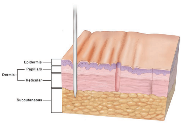 Schematic diagram of microcoring technology. From left to right, the needle pierces the skin, the delicate skin is sucked and removed, and the empty space is contracted and healed without scarring (Source: Plast Reconstr Surg Glob Open 2021;9:e3905).