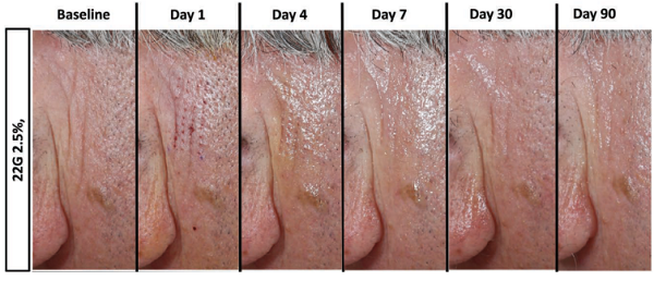 Progress after microcoring treatment. The micropores visible one day after the treatment become almost unnoticeable in a week, and the wrinkles significantly improve in 90 days. (Source: Plast Reconstr Surg Glob Open 2021;9:e3905) ).