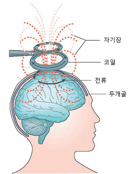 Nguyên lí của kích thích từ xuyên sọ là vùng từ trường được làm bằng cuộn cảm thông qua xương sọ đầu, và hình thành điện lưu trong não rồi điều trị (Nguồn: “kĩ thuật và ứng dụng điều chỉnh thần kinh”, xuất bản năm 2011)