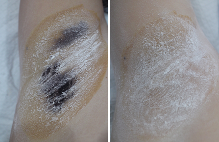 Before (left) and after (photo = provided by Director Hyun-Jo Kim) for botulinum toxin injection treatment for bromhidrosis.