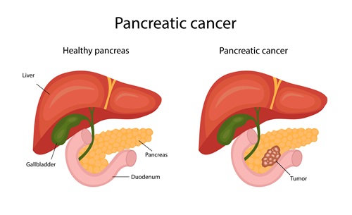 Dong Sung Pharmaceuticals' wide-area radiation therapy received clinical phase 2 approval from the Korea Food and Drug Administration, offering hope to pancreatic cancer patients (Photo=Clipart Korea).