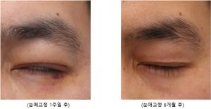 [성형부작용 완벽타파] 안검하수 개선을 위한 눈매교정술 후 부작용 해결법 - 헬스경향