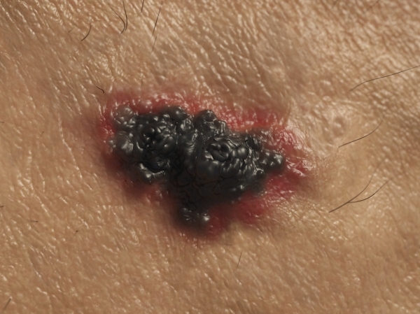 Metastatic melanoma forms due to genetic factors or environmental factors such as exposure to ultraviolet radiation and develops commonly from a congenital melanocytic nevus and dysplastic nevus (picture = Clipart Korea).