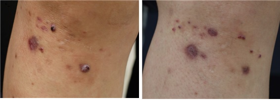 通过电能烧灼器治疗的血管中发生的多发性肿瘤（左侧:治疗前，右侧:治疗2个月后）。