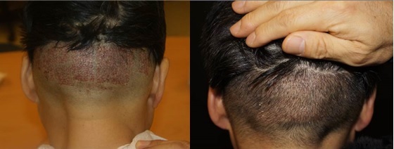 毛囊供给部位（采取部位）手术后（左）和一周后（右）。