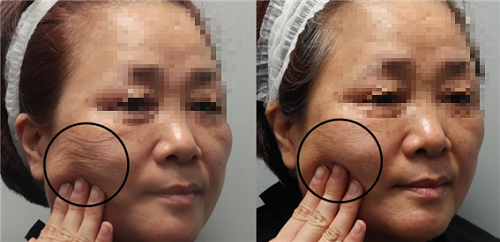 injecting Mirajet injector Before(left) and After(right) : skin elasticity and regeneration