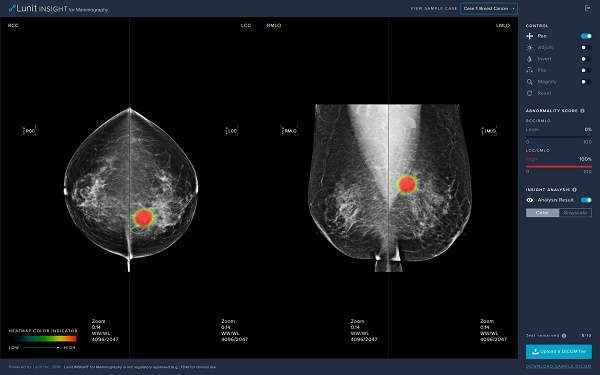 하나로 의료재단이 도입하는 ‘루닛 인사이트 MMG’는 딥러닝 기반의 인공지능 알고리즘을 적용, 96~99%의 정확도로 유방암을 검출한다.