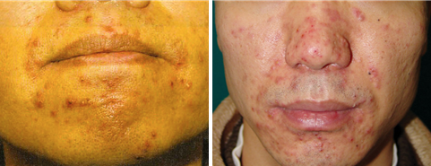 입 주위 피부염(왼쪽)과 주사(출처=피부과학7판·대한피부과학회지 2007:45:1161-9).