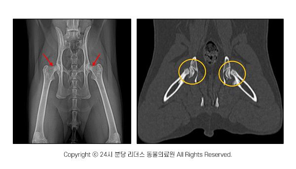 (왼쪽) 골반 방사선 복배상 이미지. 양측 대퇴골 목 부분의 골흡수 소견(→) 관찰됨. (오른쪽) 골반 CT 복배상 이미지. 양측 대퇴 골단부의 불연속성 및 변위(○) 관찰됨.